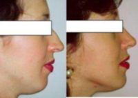 Septorhinoplasty to correct breathing difficulty and cosmetic dorsal hump deformity