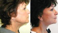 Upper and lower eyelids / face and neck lift and brow lift.