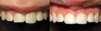 17 or under year old woman treated with Dental Bonding