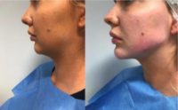 18-24 year old woman treated with Dermal Fillers