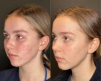 18-24 year old woman treated with AviClear