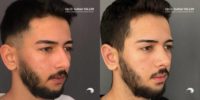 18-24 year old man treated with Rhinoplasty, Ear Surgery