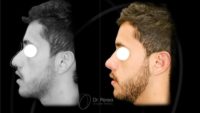 18-24 year old man treated with Rhinoplasty