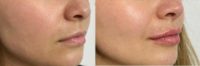 18-24 year old woman treated with Injectable Fillers