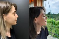 18-24 year old woman treated with Rhinoplasty