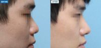 18-24 year old man treated with Asian Rhinoplasty