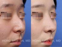 18-24 year old woman treated with Asian Rhinoplasty