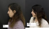 18-24 year old woman treated with Rhinoplasty