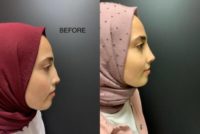 18-24 year old woman treated with Rhinoplasty