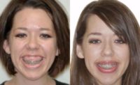 18-24 year old woman treated with Damon Braces