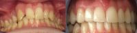 18-24 year old man treated with Dental Implant