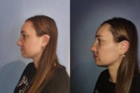 18-24 year old woman treated with Dermal Fillers