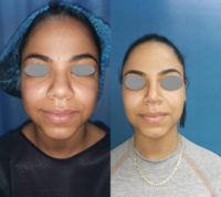 18-24 year old woman treated with African American Rhinoplasty