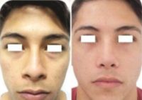 18-24 year old men treated with Rhinoplasty