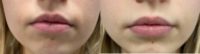 18-24 year old woman treated with Dermal Fillers