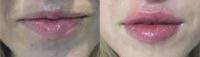 24 year old woman treated with Lip Augmentation