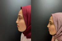 18-24 year old woman treated with Rhinoplasty