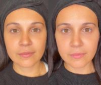 18-24 year old woman treated with Dermal Fillers