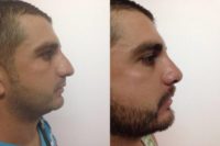 25-34 year old man treated with Rhinoplasty