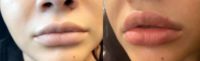 25-34 year old woman treated with Injectable Fillers