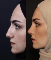 25-34 year old woman treated with Rhinoplasty, Septoplasty