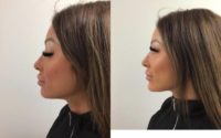 25-34 year old woman treated with Injectable Fillers