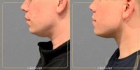 25-34 year old man treated with AirSculpt