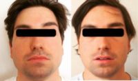 25-34 year old man treated with Buccal Fat Removal