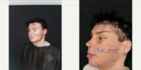 25-34 year old man treated with Jaw Reduction, Neck Lift, Facial Feminization Surgery, Forehead Reduction, Cheek Lift, Canthopla