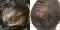 25-34 year old man treated with PRP for Hair Loss