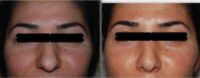 25-34 year old woman treated with Rhinoplasty