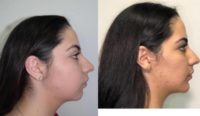 25-34 year old woman treated with Chin Surgery