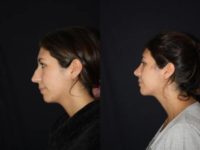 28 year old woman treated with Rhinoplasty