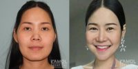 25-34 year old woman treated with Facial Reconstructive Surgery