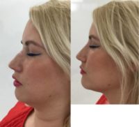 25-34 year old woman treated with Nonsurgical Nose Job