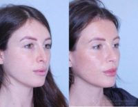 25-34 year old woman treated with Revision Rhinoplasty