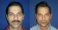 25-34 year old man treated with Chin Implant and Jaw implants (mandibular angle augmentation)-Greece