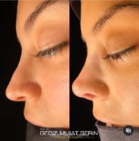 25-34 year old woman treated with Revision Rhinoplasty