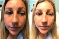 25-34 year old woman treated with Eye Bags Treatment