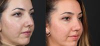 25-34 year old woman treated with Ultrasonic Rhinoplasty