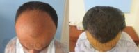 31 year old man treated with FUE Hair Transplantation method