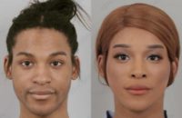 25-34 year old man treated with Facial Feminization Surgery