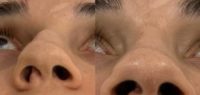 25-34 year old woman treated with Rhinoplasty