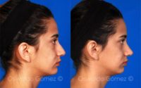 25-34 year old woman treated with Rhinoplasty