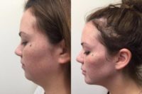 25-34 year old woman treated with Non Surgical Face Lift