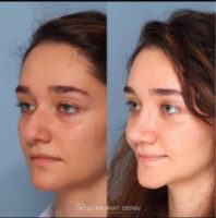 25-34 year old woman treated with Rhinoplasty