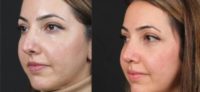 25-34 year old woman treated with Ultrasonic Rhinoplasty