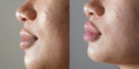 25-34 year old woman treated with Lip Fillers