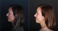 25-34 year old woman treated with Rhinoplasty