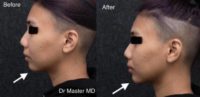 25-34 year old woman treated with Chin Filler